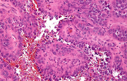 картинка гемангиосаркомы